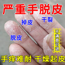 手脱皮严重脱皮专用真菌蜕皮干燥起皮药膏护手霜脱皮干裂用什么药